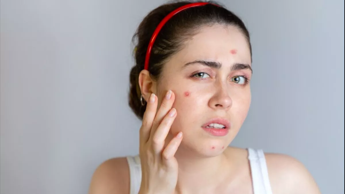 पिंपल के निशान